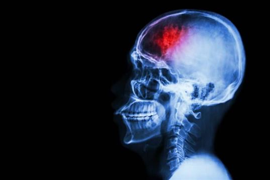 Prawdy i mity o udarze mózgu