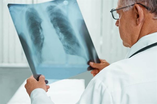 Gruźlica płuc – co warto wiedzieć
