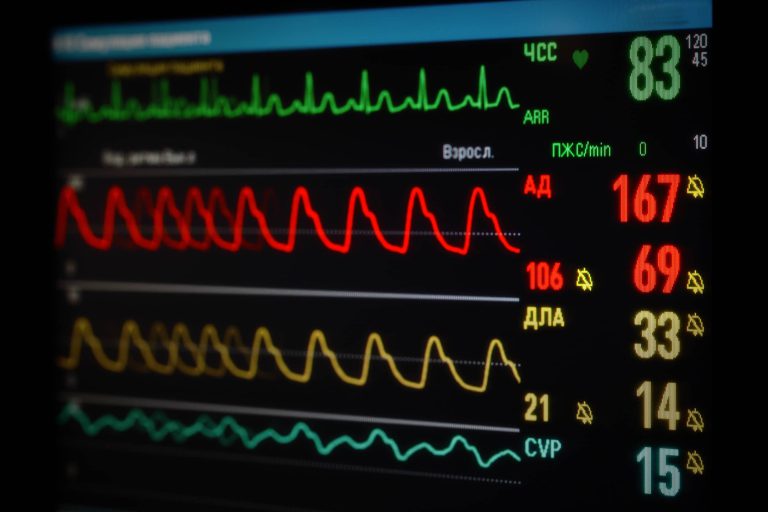 zespół chorej zatoki - wyświetlacz EKG